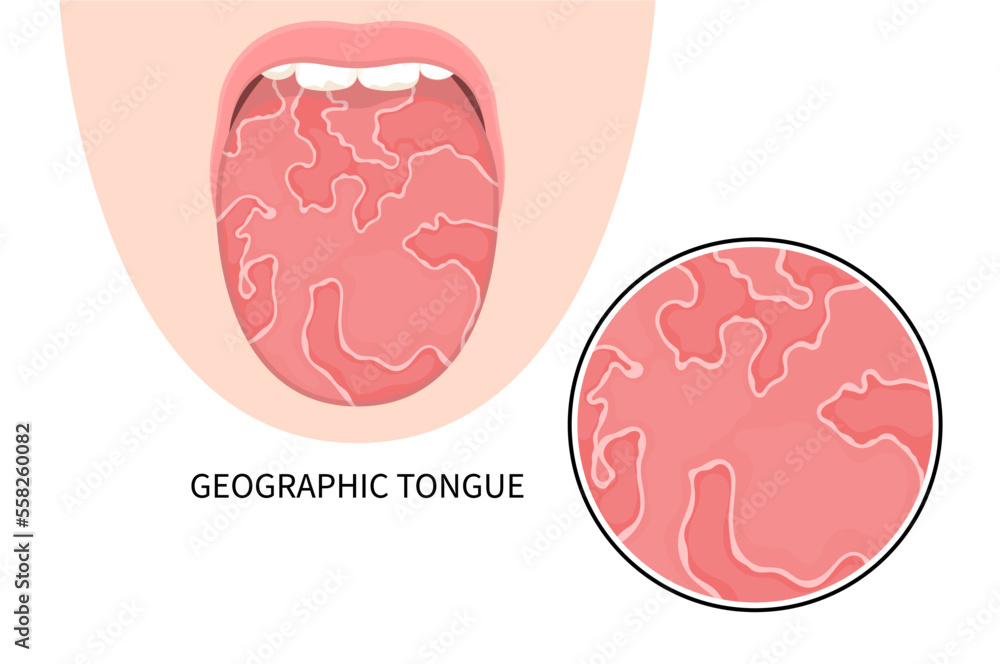 Vecteur Stock Throat cancer ulcer swelling oral inflamed pain angular