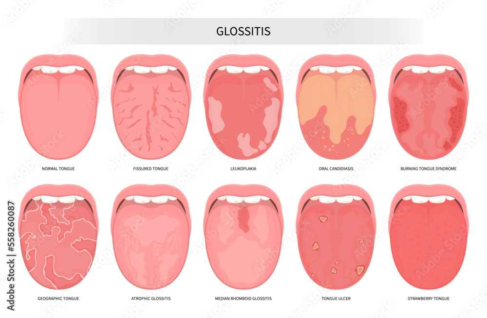 Fototapeta Oral inflamed pain angular canker sore viral pink mouth