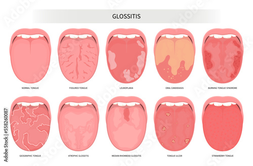 Oral inflamed pain angular canker sore viral pink mouth trauma cancer ulcer burnt throat tonsils gums dry of hunter median celiac swelling iron virus fungal B12 anemia immune system red fever