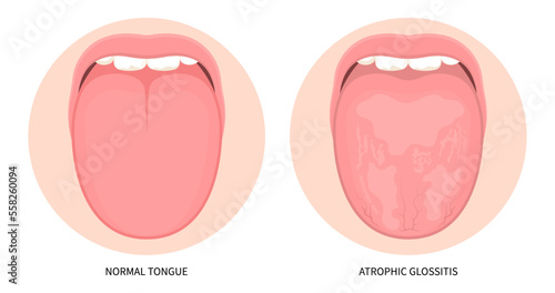 Swelling oral pink throat canker sore in mouth cancer ulcer inflamed pain angular viral trauma burnt tonsils gums dry of hunter median celiac iron virus fungal B12 anemia immune system red fever