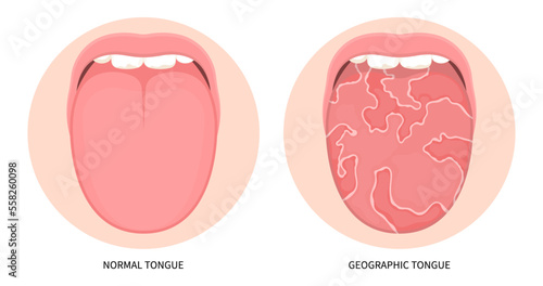 Iron anemia immune system trauma in mouth cancer ulcer swelling oral inflamed pain angular canker sore viral pink burnt throat tonsils gums dry of hunter median celiac virus fungal B12 red fever