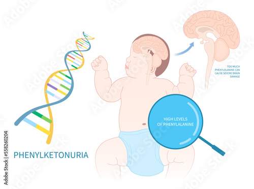 Newborn with Phenylketonuria disorder diagnose inherit problem seizures
