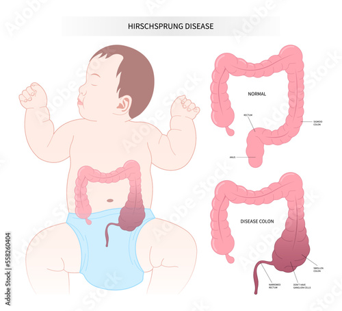 Baby diarrhea disorder intestinal disease of Hirschsprung's nerves inflammation blocked swollen belly tummy ache sepsis Down keyhole peritonitis incontinence large intestine