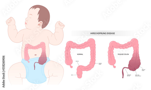 intestinal disease of Hirschsprung's nerves inflammation blocked swollen belly tummy ache sepsis Down keyhole peritonitis incontinence large intestine Diarrhea disorder