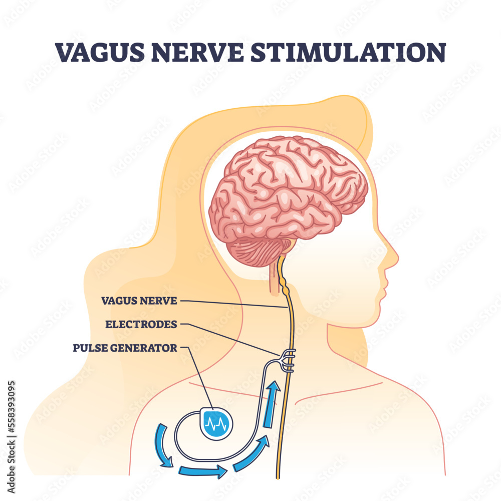Vagus nerve stimulation as medical device implant for brain outline