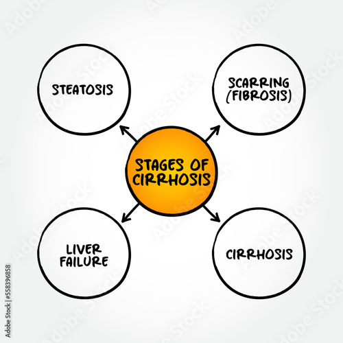 Stages of cirrhosis (scarring of the liver caused by long-term liver damage) mind map text concept for presentations and reports