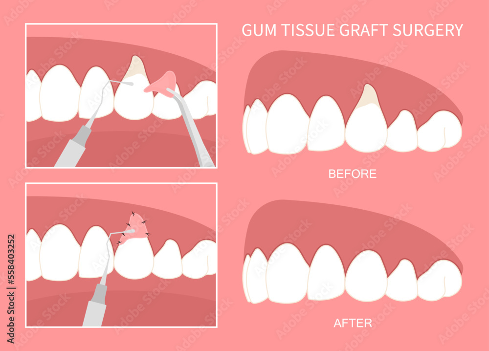 Teeth grafting procedure for recession gummy smile buildup swelling
