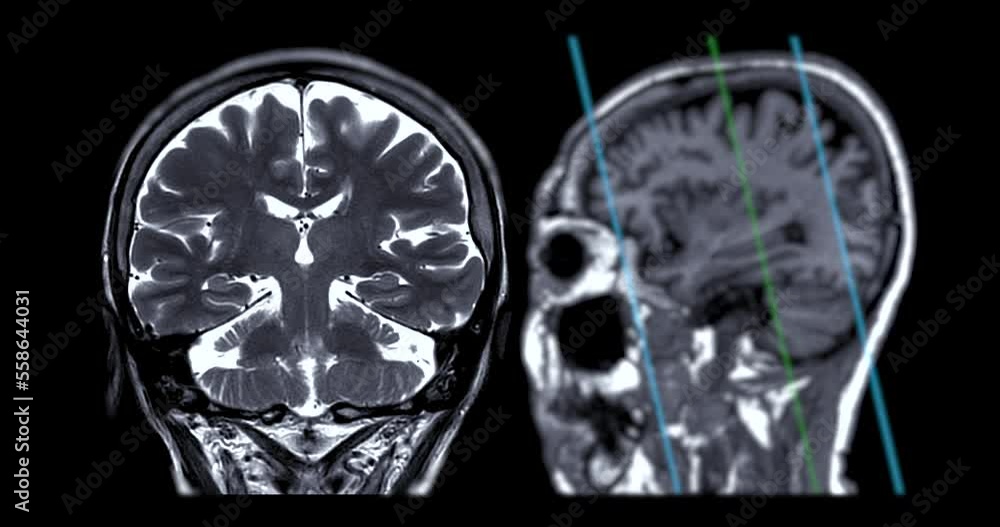 MRI Brain Coronal T2w oblique can help doctors look for conditions dementia. MRI Brain Coronal T2w oblique can help doctors look for conditions dementia.