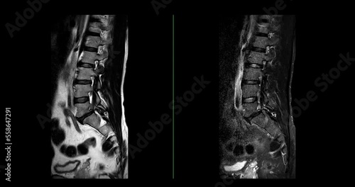 MRI L-S spine or lumbar spine sagittal T2W and T2W Fat suppression for diagnosis spinal cord compression. photo