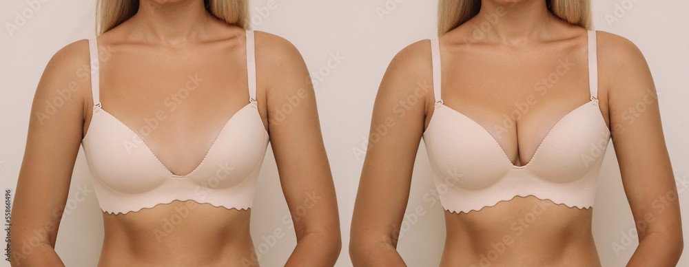 Young tanned blonde woman in bra before and after breast augmentation with  silicone implants. The result of a breast lift. Breast size correction on  beige background. Plastic surgery concept Stock Photo