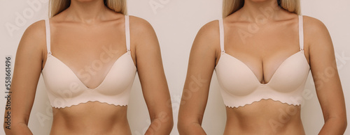 Young tanned blonde woman in bra before and after breast augmentation with silicone implants. The result of a breast lift. Breast size correction on beige background. Plastic surgery concept