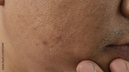 Cheeks of people with skin problems, acne, large pores and dull skin