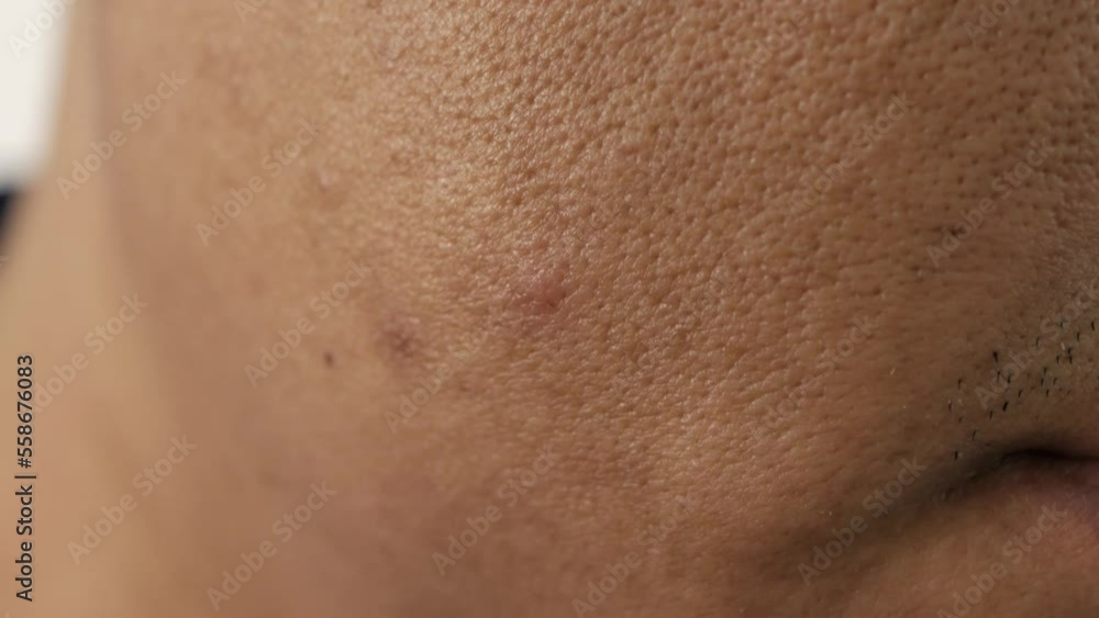 Cheeks of people with skin problems, acne, large pores and dull skin Cheeks of people with skin problems, acne, large pores and dull skin