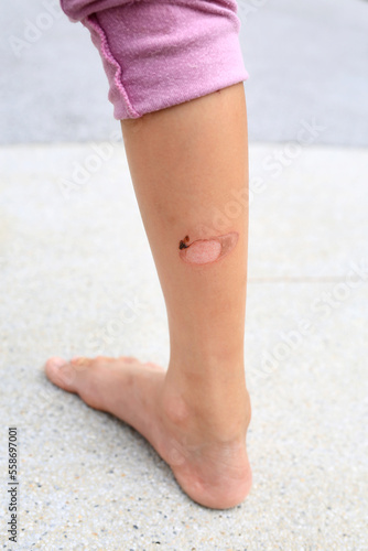 Child Leg wounds caused by hot blanching from motorcycle exhaust pipes.