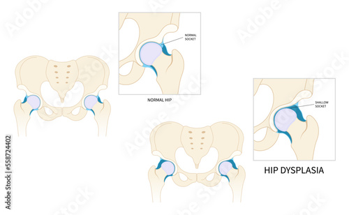 Thighbone joint dislocated broken pain of leg bone treat unstable femur pelvis chronic damage sport nerve sciatic compression labral tear child hurt thigh closed loose baby birth neck and prosthesis photo