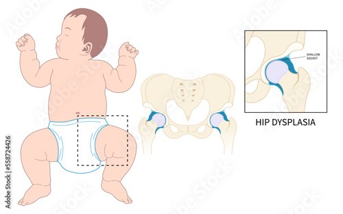Baby birth and prosthesis damage thighbone joint dislocated broken pain of leg bone treat unstable femur pelvis chronic sport nerve sciatic compression labral tear child hurt thigh closed loose neck