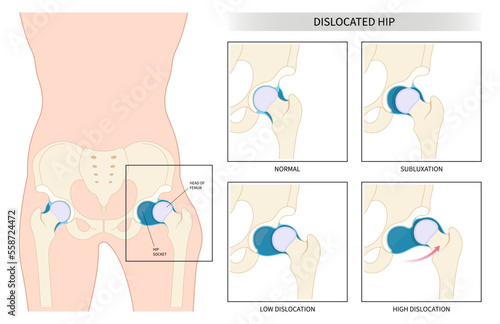 Leg bone prosthesis hurt and thighbone joint dislocated broken pain of treat unstable femur chronic damage sport nerve sciatic compression labral tear child baby birth loose pelvis neck thigh closed