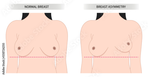 One breast bigger than pain examine density milk gland duct test Lump Malignant cyst large woman Implant Sagging mass size Lift Fat Transfer small shape