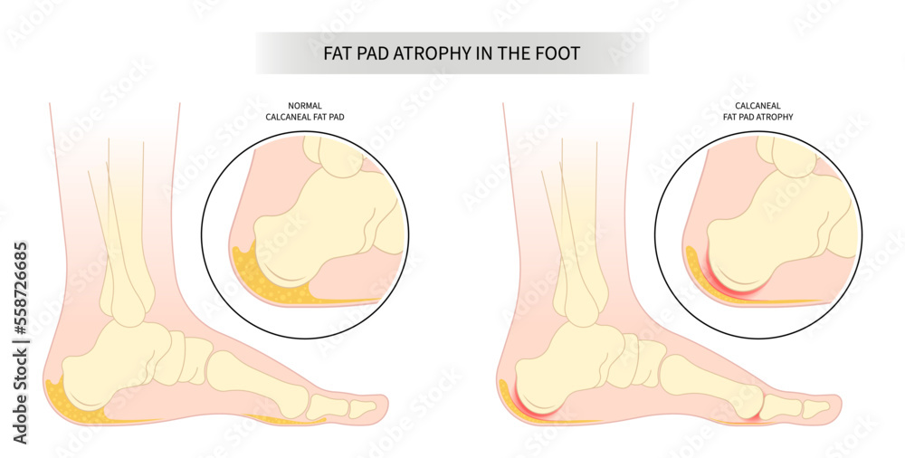 achilles-tendon-tear-painful-and-plantar-fat-pad-atrophy-high-heel