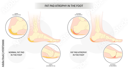 Plantar fat pad atrophy painful high heel ankle shoes bone spurs feet sport fascia arch of Lupus shots Steroid tear Achilles tendon photo