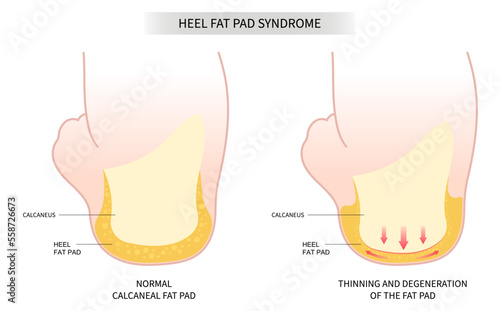 Achilles tendon tear painful and Plantar fat pad atrophy high heel ankle shoes bone spurs feet sport fascia arch of Lupus shots Steroid photo