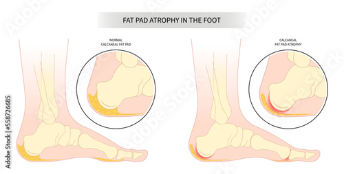 Achilles tendon tear painful and Plantar fat pad atrophy high heel ankle shoes bone spurs feet sport fascia arch of Lupus shots Steroid