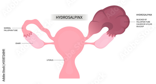 laparoscopic artificial insemination ovary Surgery abdominal organs Uterine female adhesions Pelvic women vaginal cyst discharge pain cancer Tubal Occlusion system in tube photo