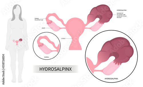 ovary Surgery abdominal organs Uterine female laparoscopic adhesions artificial insemination Pelvic women vaginal cyst discharge pain cancer Tubal Occlusion system in tube