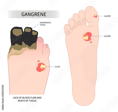 Diabetic foot syndrome skin toe acute sore pain amputation cell bacteria traumatic fungus and sunburn of Raynaud's vascular limb ischemic leg cold pus dry wet gas necrotizing fasciitis artery