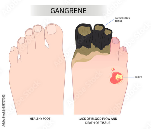 Necrotizing fasciitis artery syndrome diabetic foot skin toe acute sore pain amputation cell bacteria traumatic fungus and sunburn of Raynaud's vascular limb ischemic leg cold pus dry wet gas photo