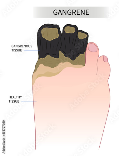 Foot cell bacteria traumatic fungus syndrome and diabetic sunburn of Raynaud's vascular limb ischemic leg skin toe acute sore pain cold pus dry wet gas necrotizing fasciitis artery amputation