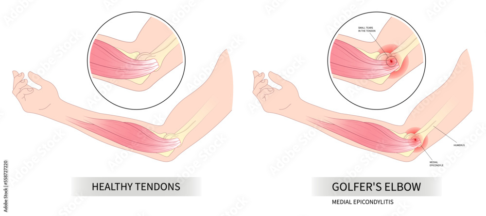 Εκτύπωση καμβά sport injury in pronation wrist Golfer's elbow pain common radial flexion rotato