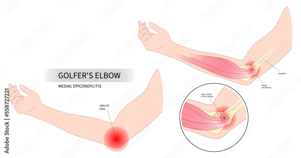 Anatomy common radial flexion nerve for Golfer's elbow pain sport