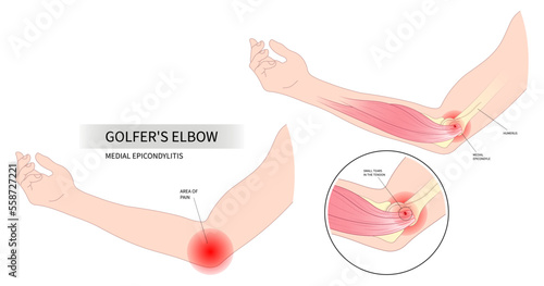 Foto Anatomy common radial flexion nerve for Golfer's elbow pain sport injury in pron