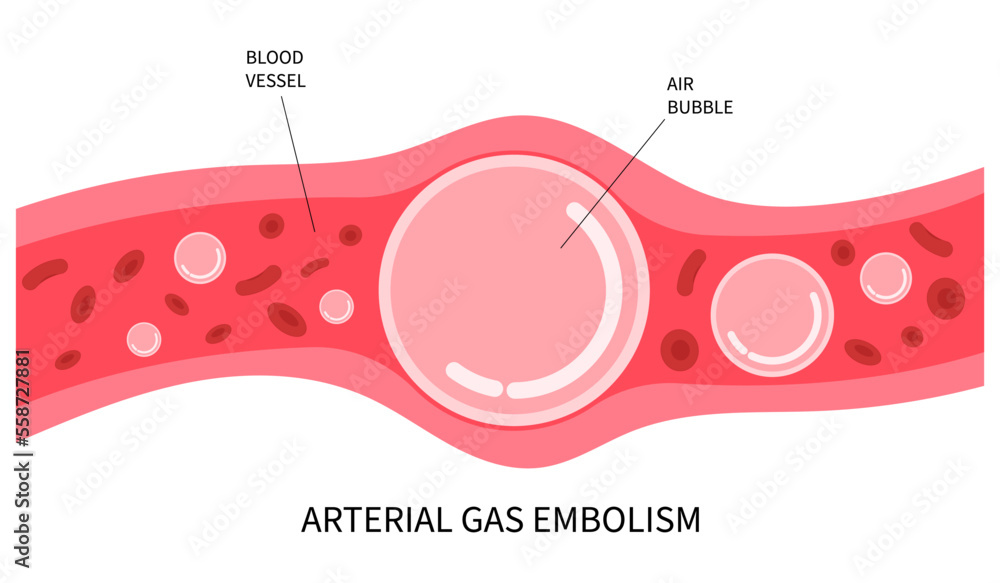 Air oxygen gas high lung symptom diver loss of appetite and Henry's carbon law the prevent self