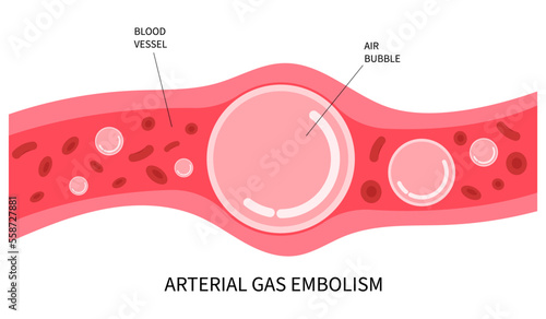 Air oxygen gas high lung symptom diver loss of appetite and Henry's carbon law the prevent self contained apparatus depth accident system double vision