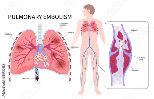 Acute limb ischemia with thrombus block arteries blood vessel chest pain edema clot chronic cough of lung air stroke spider vein high swelling knee ulcer leg foot calf post thrombotic