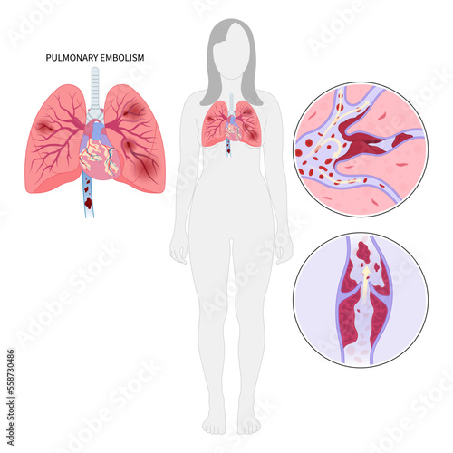 Post thrombotic lung edema blood clot chronic cough chest pain of stroke leg thrombus air spider vein high block vessel arteries acute limb ischemia swelling knee ulcer foot calf