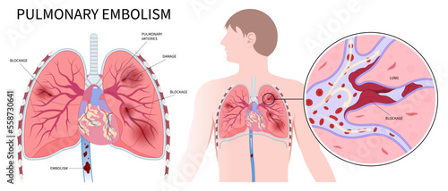 Post thrombotic lung edema blood clot chronic cough chest pain of stroke leg thrombus air spider vein high block vessel arteries acute limb ischemia swelling knee ulcer foot calf photo