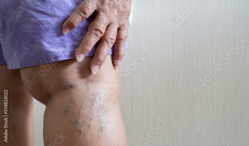 Varicose veins in an elderly woman. Inflamed dilated veins in the legs. photo