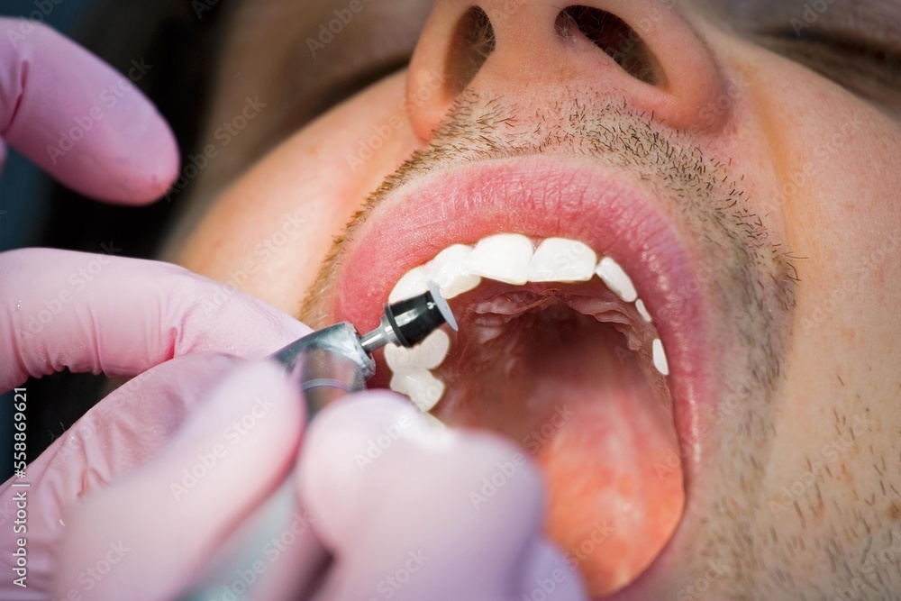 dentist; grind; bleach; mouth; tongue; medicine; anterior tooth; treat