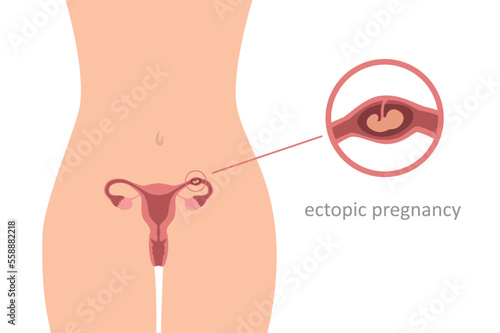 ectopic pregnancy info graphic womens health embryo