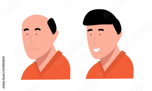 baldness man person