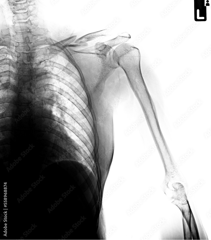 Fracture left clavicle x-ray antero-posterior Fracture left clavicle x-ray antero-posterior