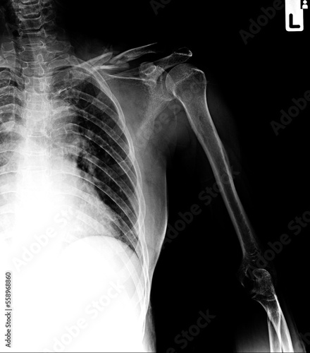 Fracture left clavicle x-ray antero-posterior  photo