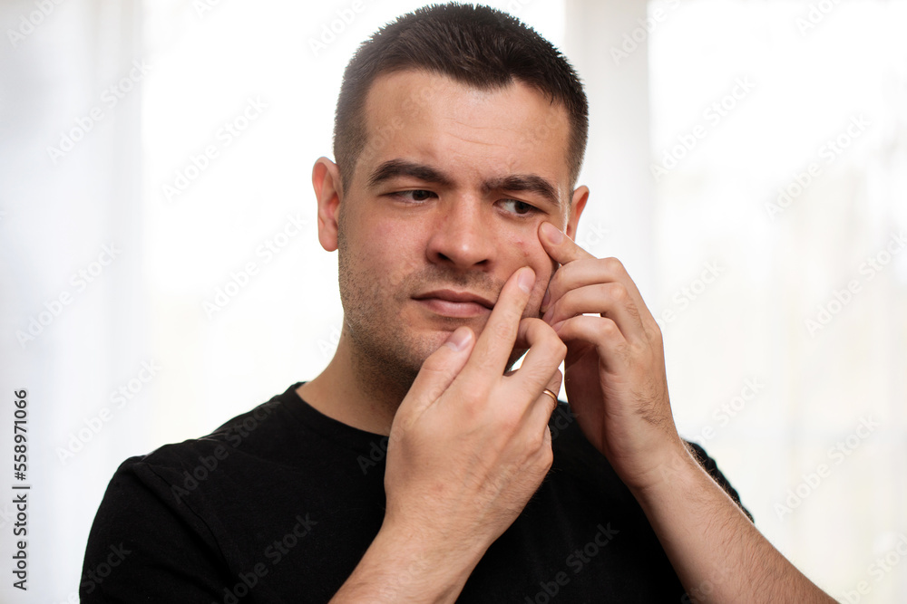 the guy squeezes a pimple on his face on a light background