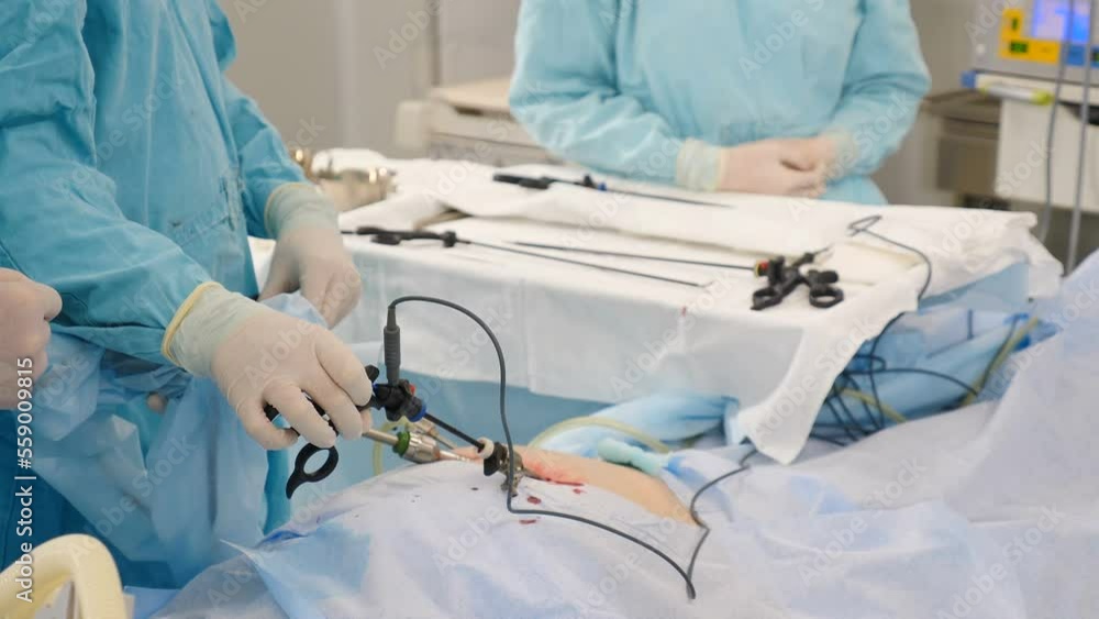Laparoscopic cholecystectomy instrument. Real Surgery, abdominal