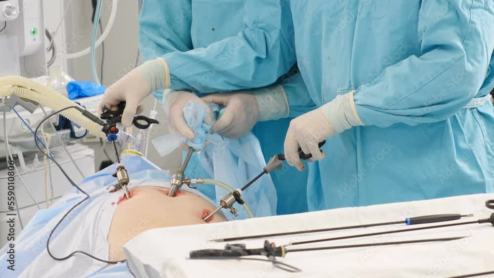 Laparoscopic cholecystectomy instrument. Real Surgery, abdominal incision, working with surgical