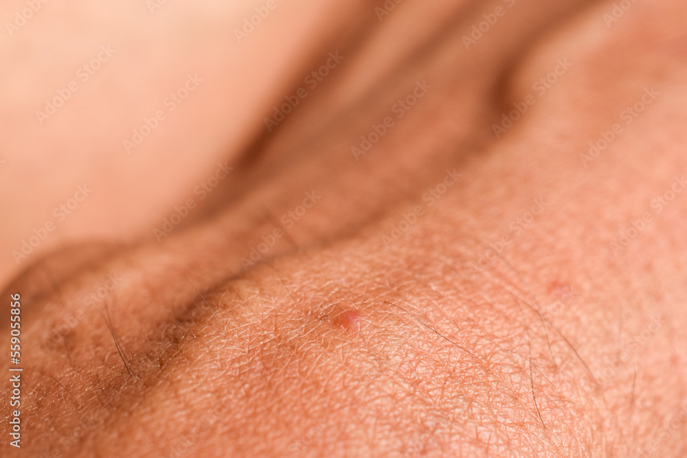 Fototapeta premium Tan human skin background, blister, mosquito bite mark, close up