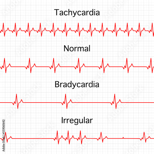Heart rate graphics. Vector illustration. Electrocardiogram. illustration of medical electrocardiogram - ECG on chart paper. Tachycardia, normal, Bradycardia, Irregular heart beat.